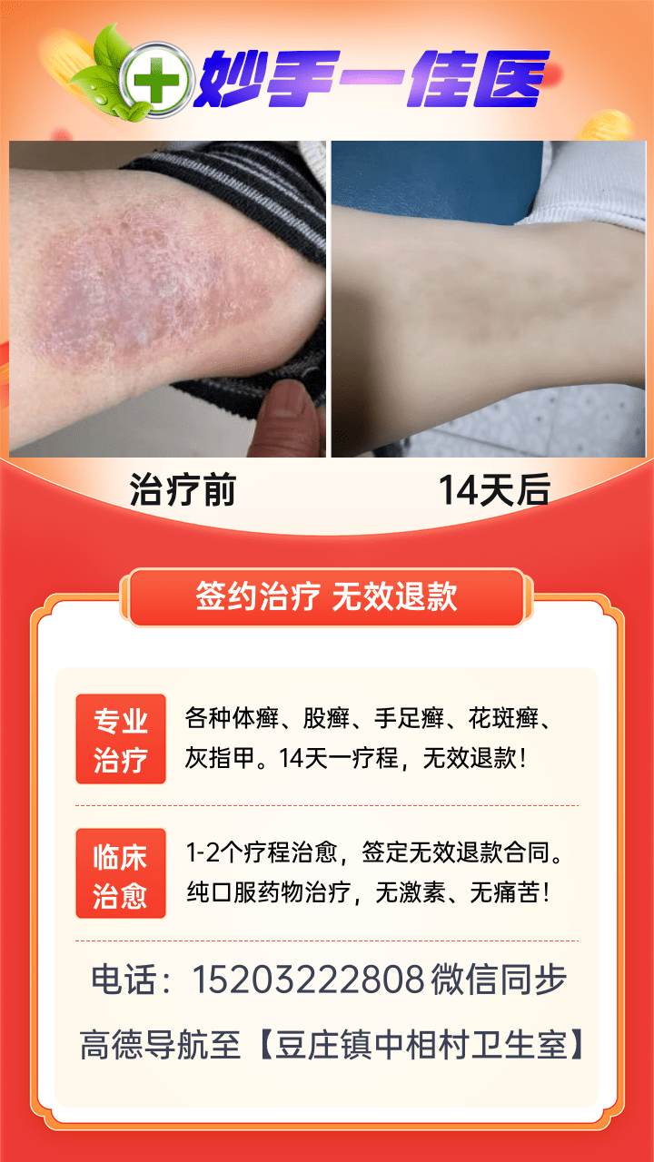 专业治疗皮肤癣病